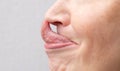 The Gorlin sign is a medical term that indicates the ability to touch the tip of the nose with the tongue.