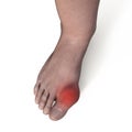 Gout-afflicted foot, 3D illustration