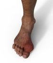 Gout-afflicted foot, 3D illustration