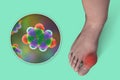 Gout-afflicted foot, 3D illustration