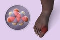 Gout-afflicted foot, 3D illustration