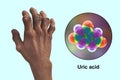 Gout-afflicted hands with deformities, 3D illustration