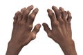 Gout-afflicted hands with deformities, 3D illustration