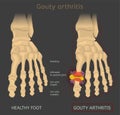 Gout arthritis image Royalty Free Stock Photo