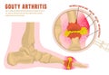 Gout arthritis infographic Royalty Free Stock Photo