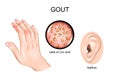 Gout, arthritis, tofus.