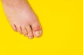 Gout on the big toe appears as redness and a unbearable pain