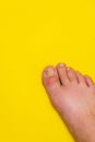 Gout on the big toe appears as redness and a unbearable pain
