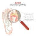 Gout. Close-up of joint with inflammatory arthritis