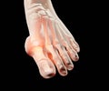 Gout inflammatory arthritis on human feet toe finger Royalty Free Stock Photo