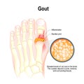 Gout is a form of inflammatory arthritis. Royalty Free Stock Photo