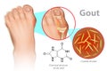 Gout is a form of inflammatory arthritis Royalty Free Stock Photo