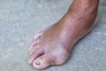 Gout inflammation on big toe joint and fungal nail infection Royalty Free Stock Photo