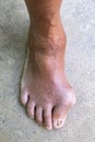 Gout inflammation on big toe joint and fungal nail infection