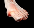 Gout inflammatory arthritis on human feet toe finger Royalty Free Stock Photo