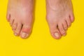 Gout or podagra on the big toe appears as redness and a unbearable pain