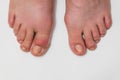 Gout or podagra on the big toe appears as redness and a unbearable pain