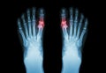 Gout , Rheumatoid arthritis ( Film x-ray both foot and arthritis at first metatarsophalangeal joint ) ( Medicine and Science Royalty Free Stock Photo