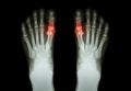 Gout , Rheumatoid arthritis ( Film x-ray both foot and arthritis at first metatarsophalangeal joint ) ( Medicine and Science Royalty Free Stock Photo