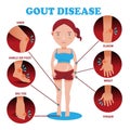 Gout symptoms