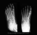 Gouty arthritis . film x-ray of left foot front and side view .