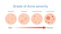 Grade of acne severity. Medical diagram about skin problems from acne.