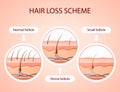 Gradient hair loss scheme Vector illustration. Royalty Free Stock Photo