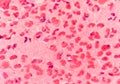 Gram negative diplococci intracellular