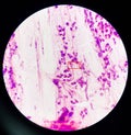 Gram-negative diplococci in vaginal smear