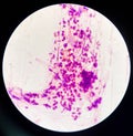 Gram-negative diplococci in vaginal smear