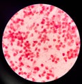 Gram-negative diplococci in vaginal smear