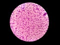 Gram positive cocci. Gram stain. Royalty Free Stock Photo