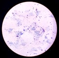 Gram stain of Arcanobacterium haemolyticum colony showing irregularly shaped gram-positive rods recovered from blood culture.