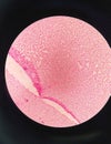 Gram staining , is a method of differentiating bacterial species. gram negative coccus