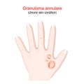 Granuloma annulare. Chronic skin condition