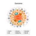 Granuloma