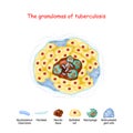 The granulomas of tuberculosis. structure of granuloma