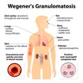 Granulomatosis