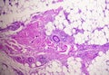 granulomatous tissue histology showing Foreign body granuloma. Royalty Free Stock Photo