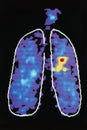 Graphic Image Showing Disease In Human Lung