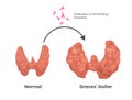 Grave`s disease cause. Antithyroid antibodies