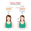 Graves` disease. toxic diffuse goiter is an autoimmune disease that affects the thyroid Royalty Free Stock Photo