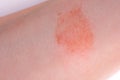 The great red spot on the skin closeup Royalty Free Stock Photo
