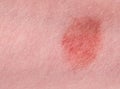 The great red spot on the skin closeup Royalty Free Stock Photo