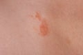 The great red spot on the skin closeup Royalty Free Stock Photo