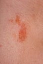 The great red spot on the skin closeup Royalty Free Stock Photo