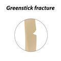 Greenstick fracture Bone. Infographics. Vector illustration on a lined background. Royalty Free Stock Photo