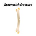 Greenstick fracture Bone. Infographics. Vector illustration on a lined background. Royalty Free Stock Photo