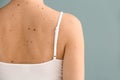 Young woman with moles on grey background Royalty Free Stock Photo