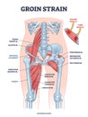 Groin strain trauma and pulled or torn muscle injury anatomy outline diagram Royalty Free Stock Photo